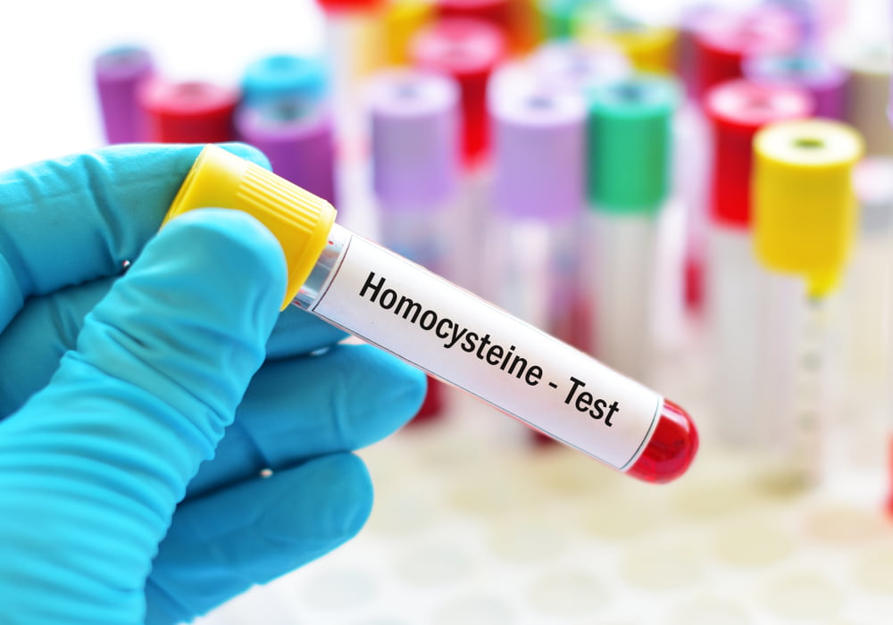 Homocysteine, a little-known cardiovascular risk factor
